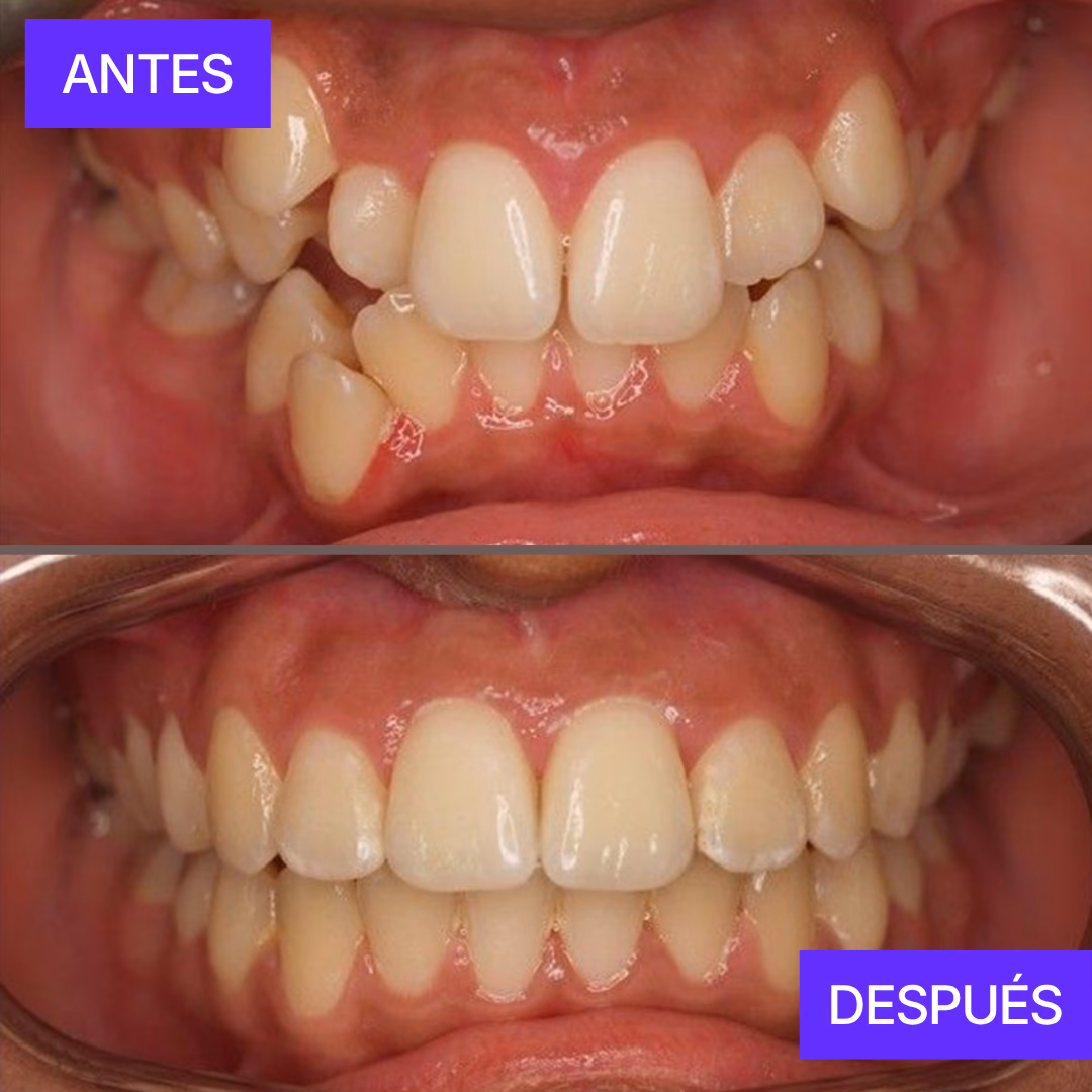 Braces Guatemala before and after results - María José 18 month transformation