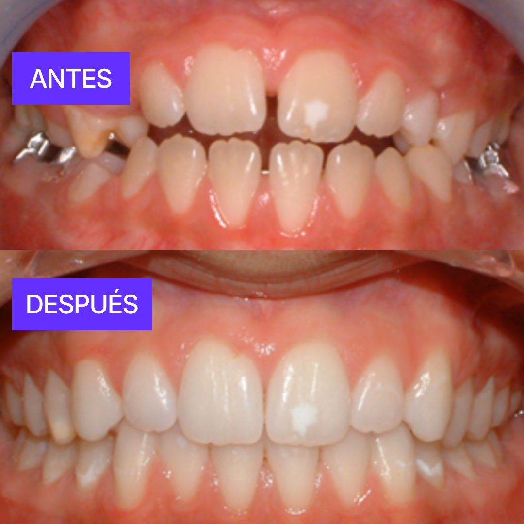 Braces Guatemala before and after results - Andrea López adult orthodontics