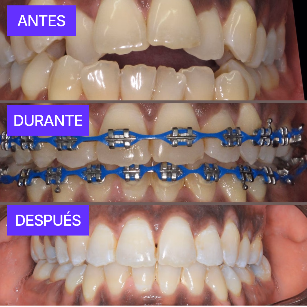 Braces Guatemala before and after results - Carlos teen orthodontics