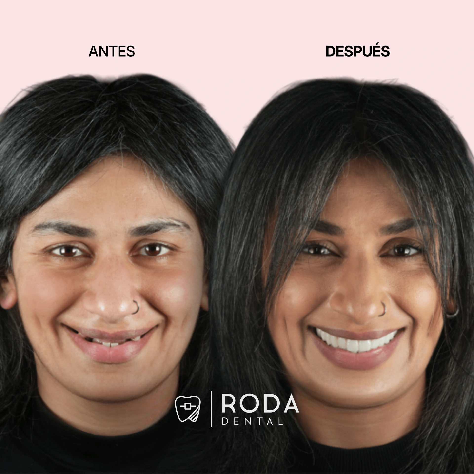 Dental implants Guatemala before and after - Claudia Flores immediate implants