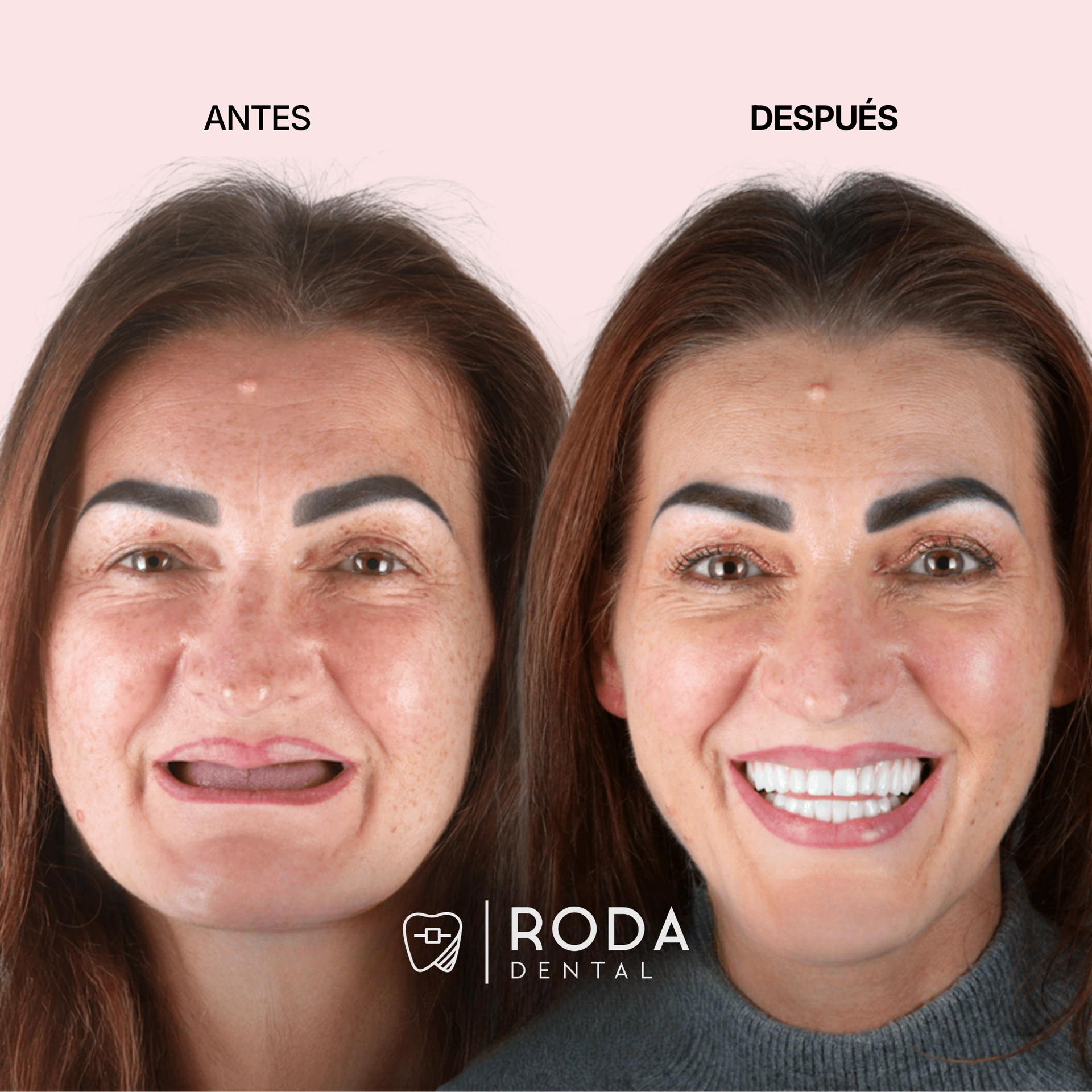 Full arch dental implants Guatemala before and after - Elena Martínez All-on-4 restoration