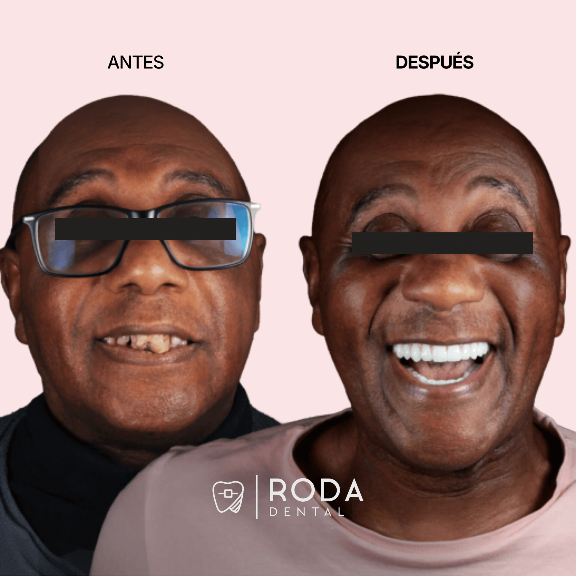 Multiple dental implants Guatemala before and after - Fernando Godoy teeth in a day