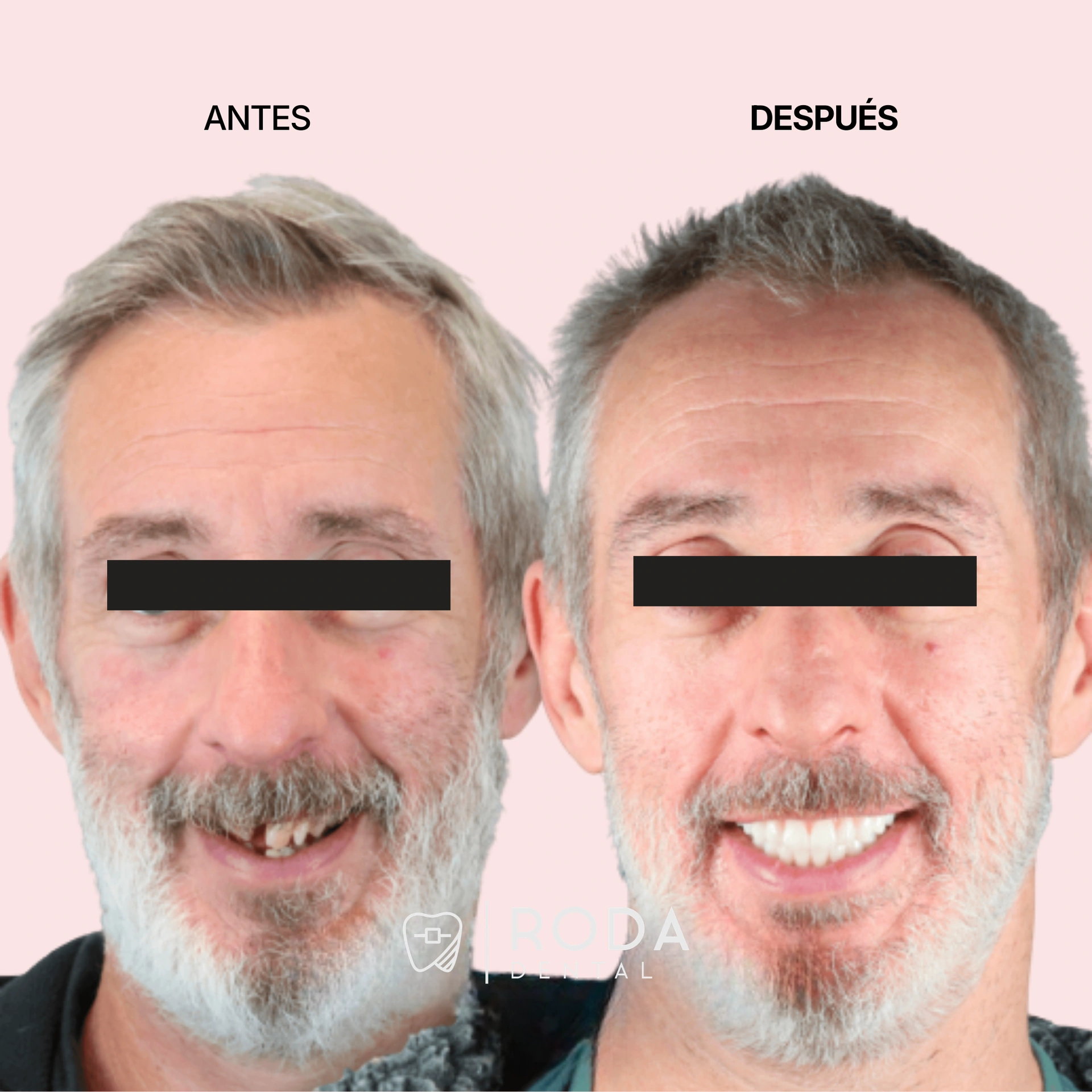 Dental implants Guatemala before and after - Hector bridge to implants conversion