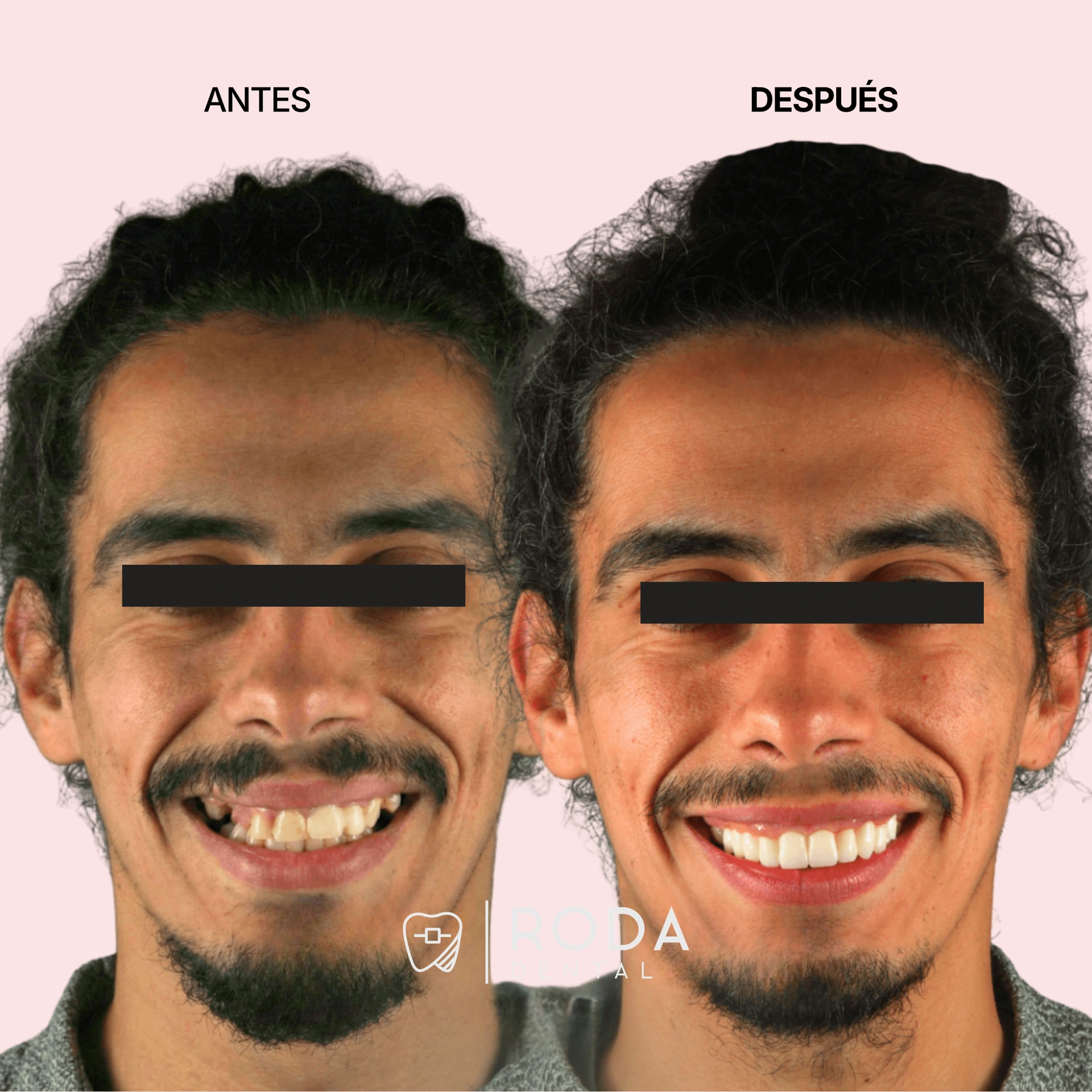 Dental implants Guatemala before and after - Jorge Ramírez full mouth restoration