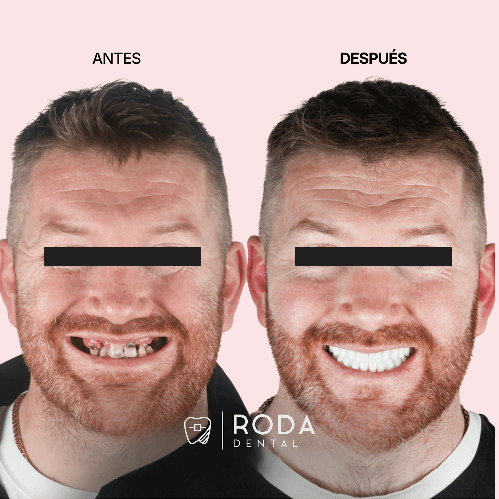 Dental implants Guatemala before and after - Mario López multiple teeth replacement