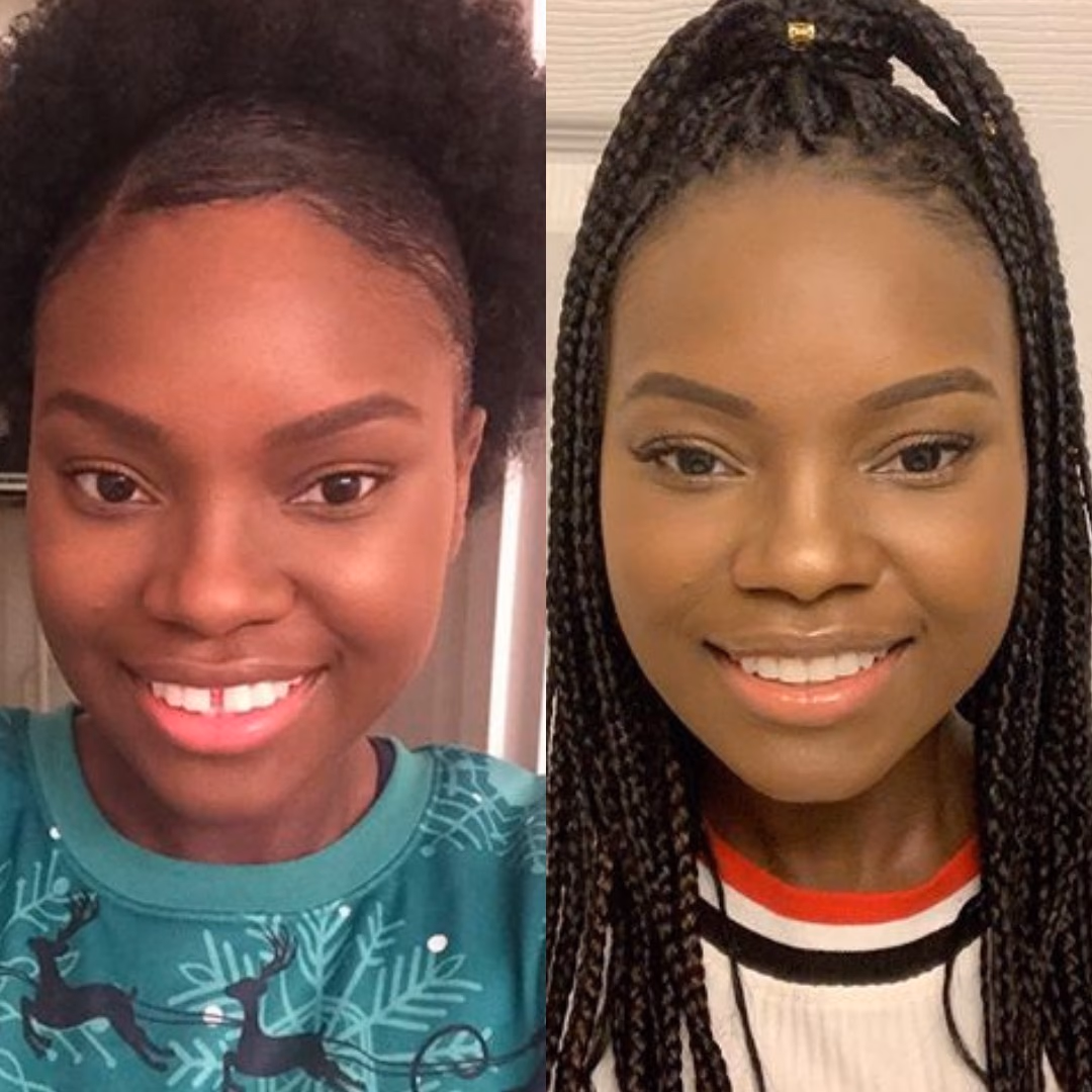 Resultados antes y después de Invisalign Guatemala - Cierre de espacio de 10 meses de Sofi Morales