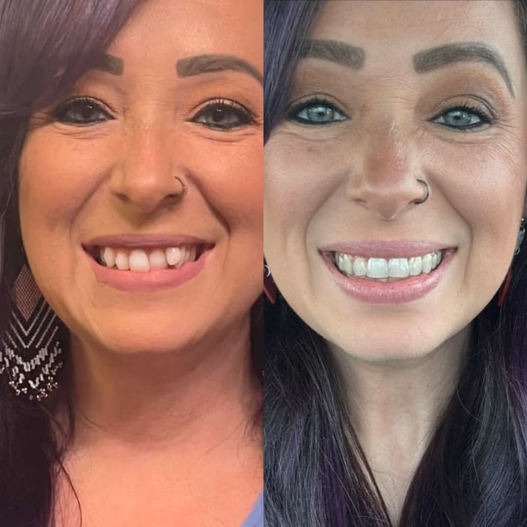 Resultados antes y después de Invisalign Guatemala - Enderezamiento dental de 10 meses de Andrea Ramírez