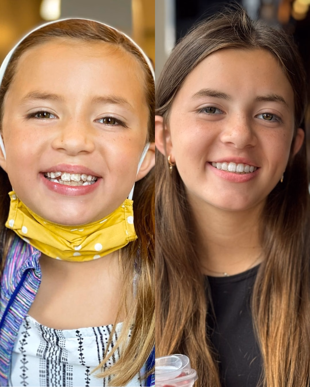 Resultados antes y después de Invisalign Guatemala - Caso de ortodoncia de 15 meses de Isabella Pérez