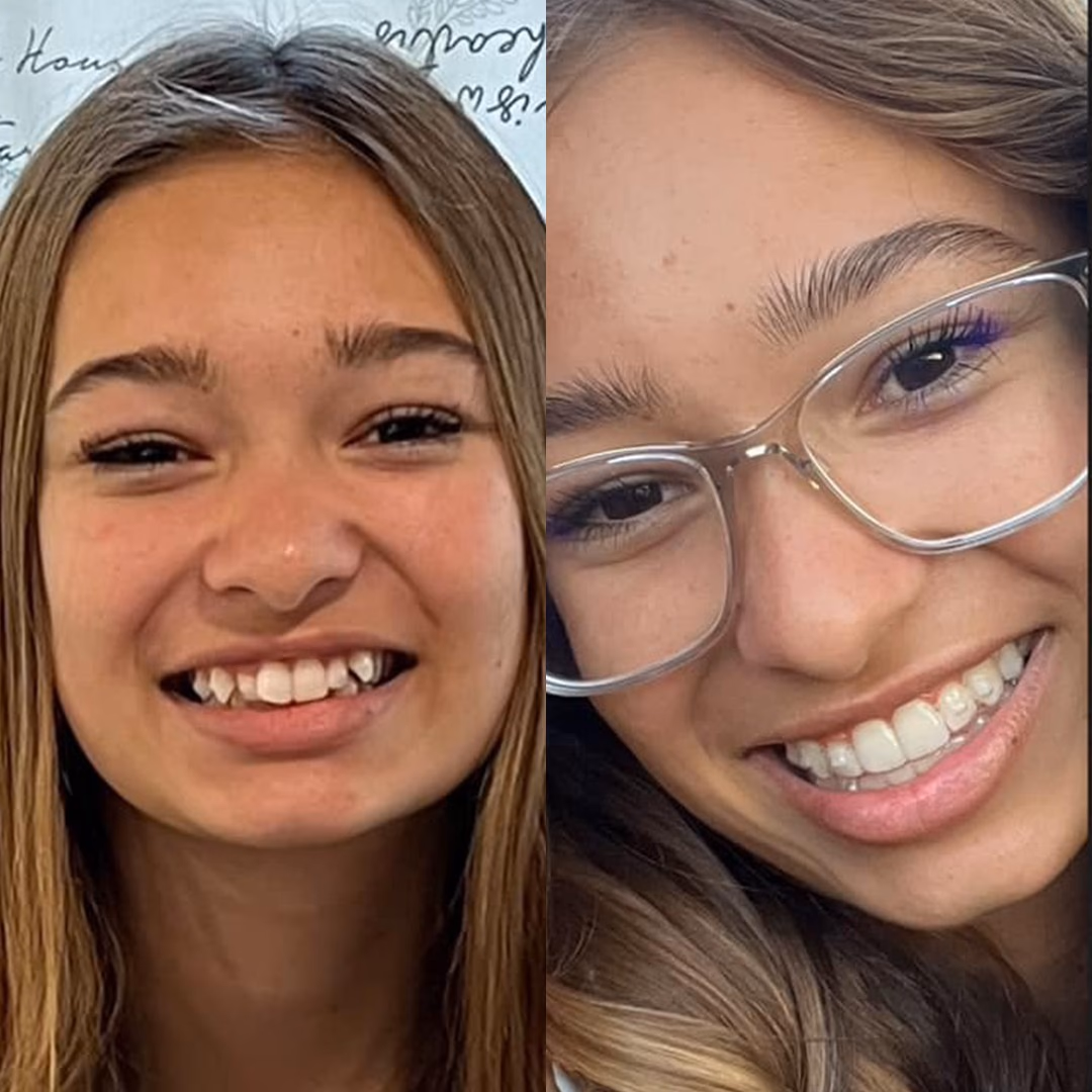 Resultados antes y después de Invisalign Guatemala - Tratamiento adolescente de 16 meses de Valentina Torres