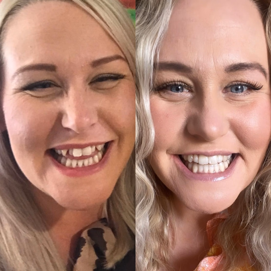 Resultados antes y después de Invisalign Guatemala - Transformación de 18 meses de Gaby Koch