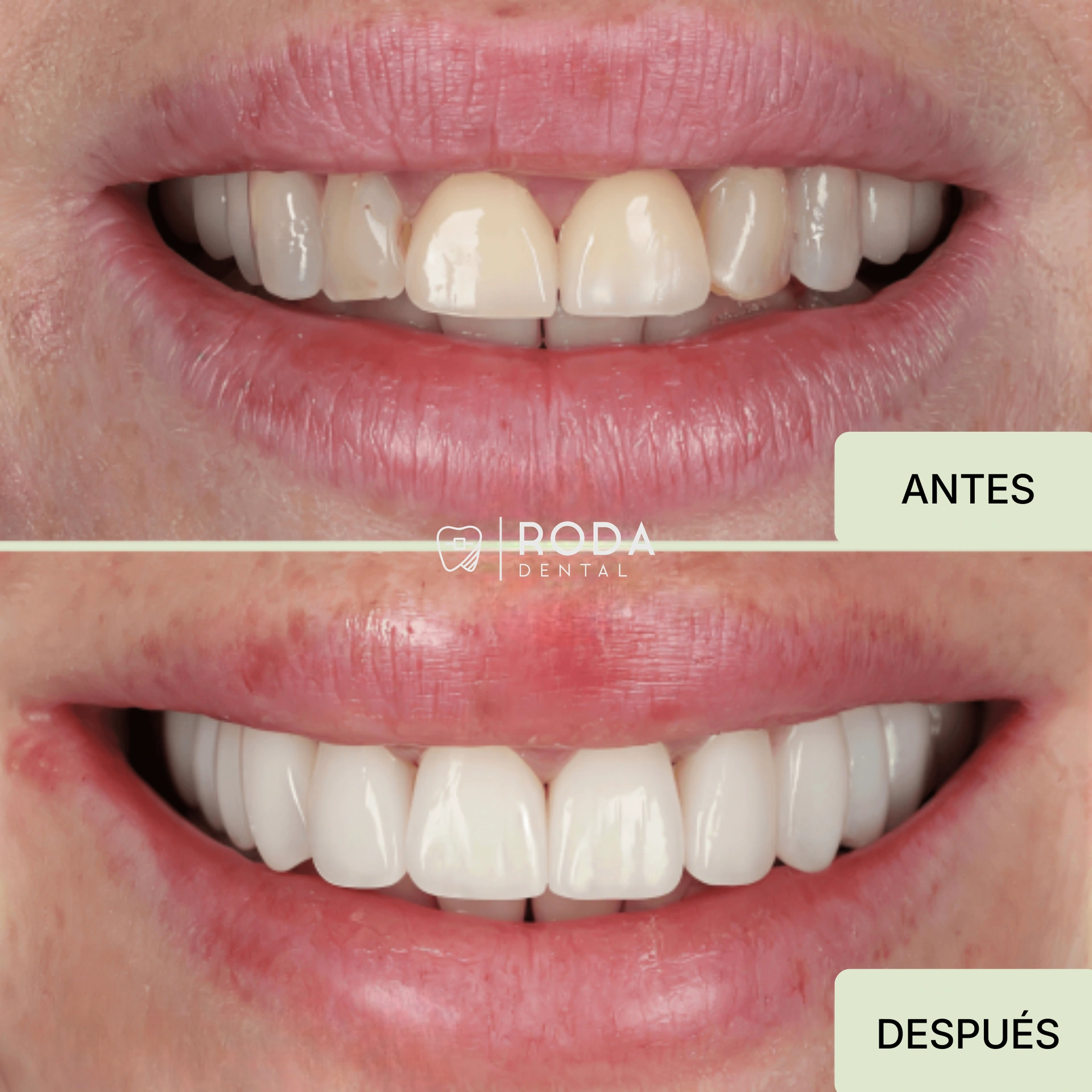 Carillas dentales Guatemala antes y después - resultados naturales Andrea Morales