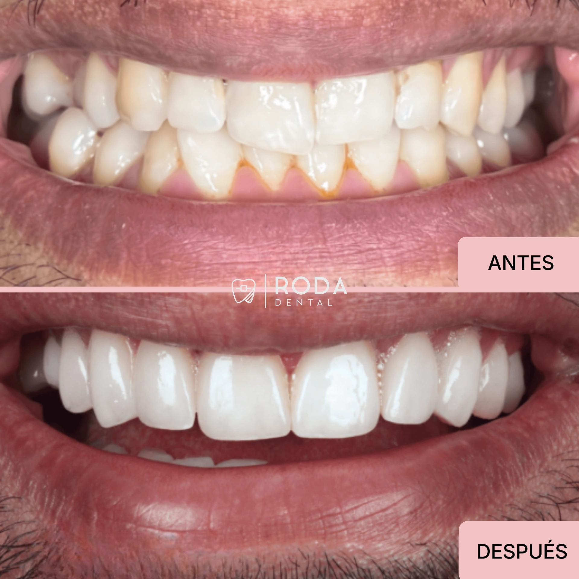 Carillas dentales Guatemala antes (dientes descoloridos y quebrados) y después - transformación completa Carlos Eduardo