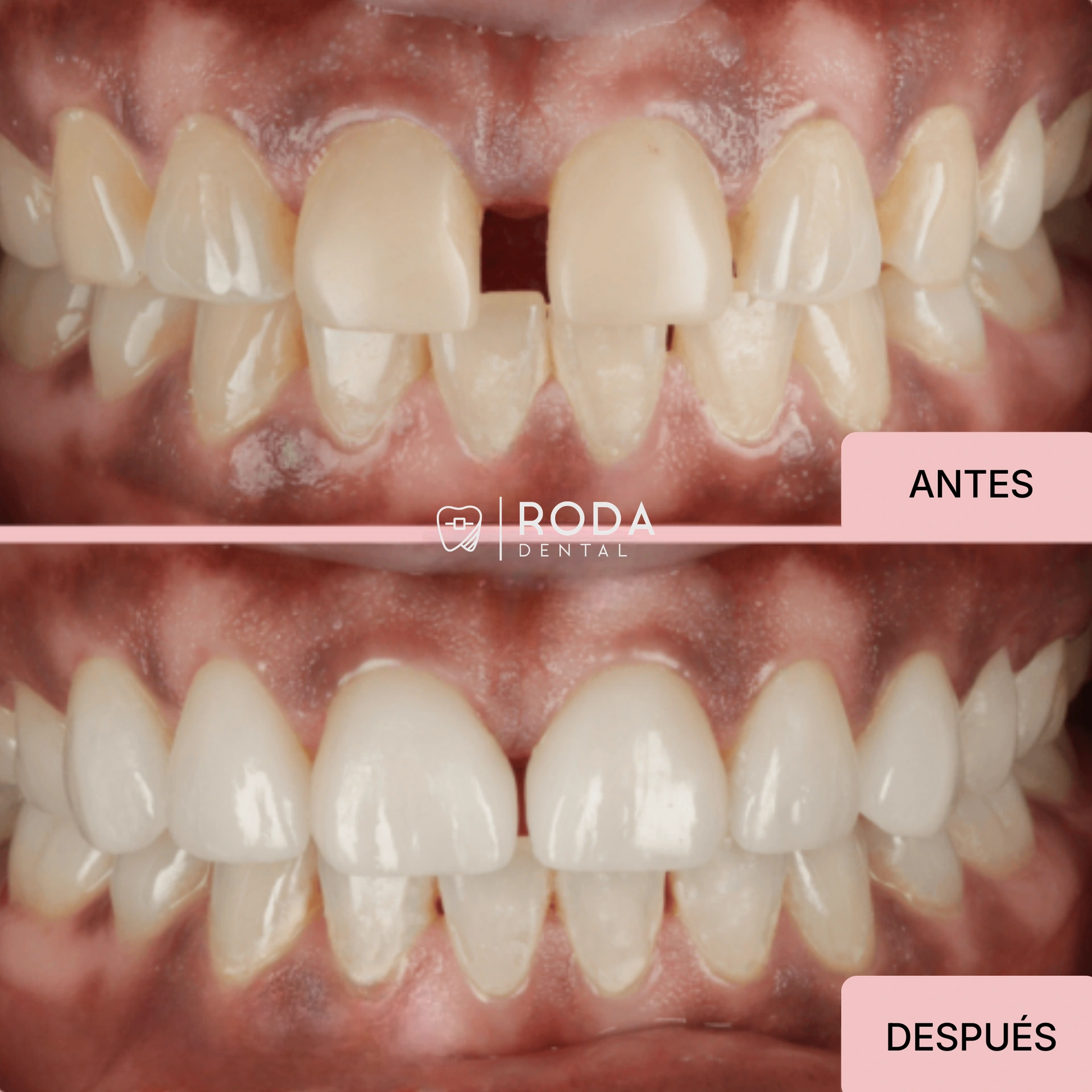 Carillas dentales Guatemala antes y después - corrección de espacio y astilla Fernando