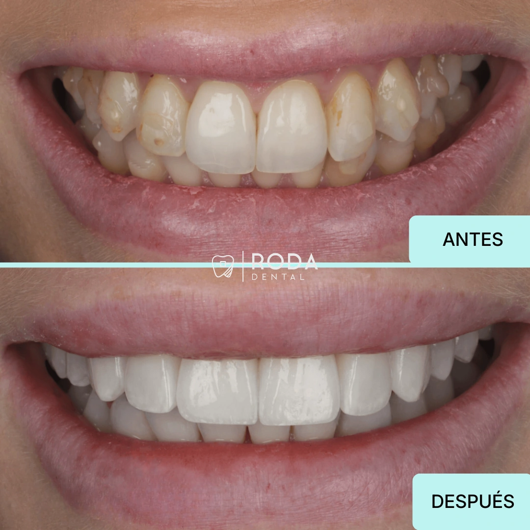 Carillas dentales Guatemala antes y después - transformación de sonrisa María Fernanda