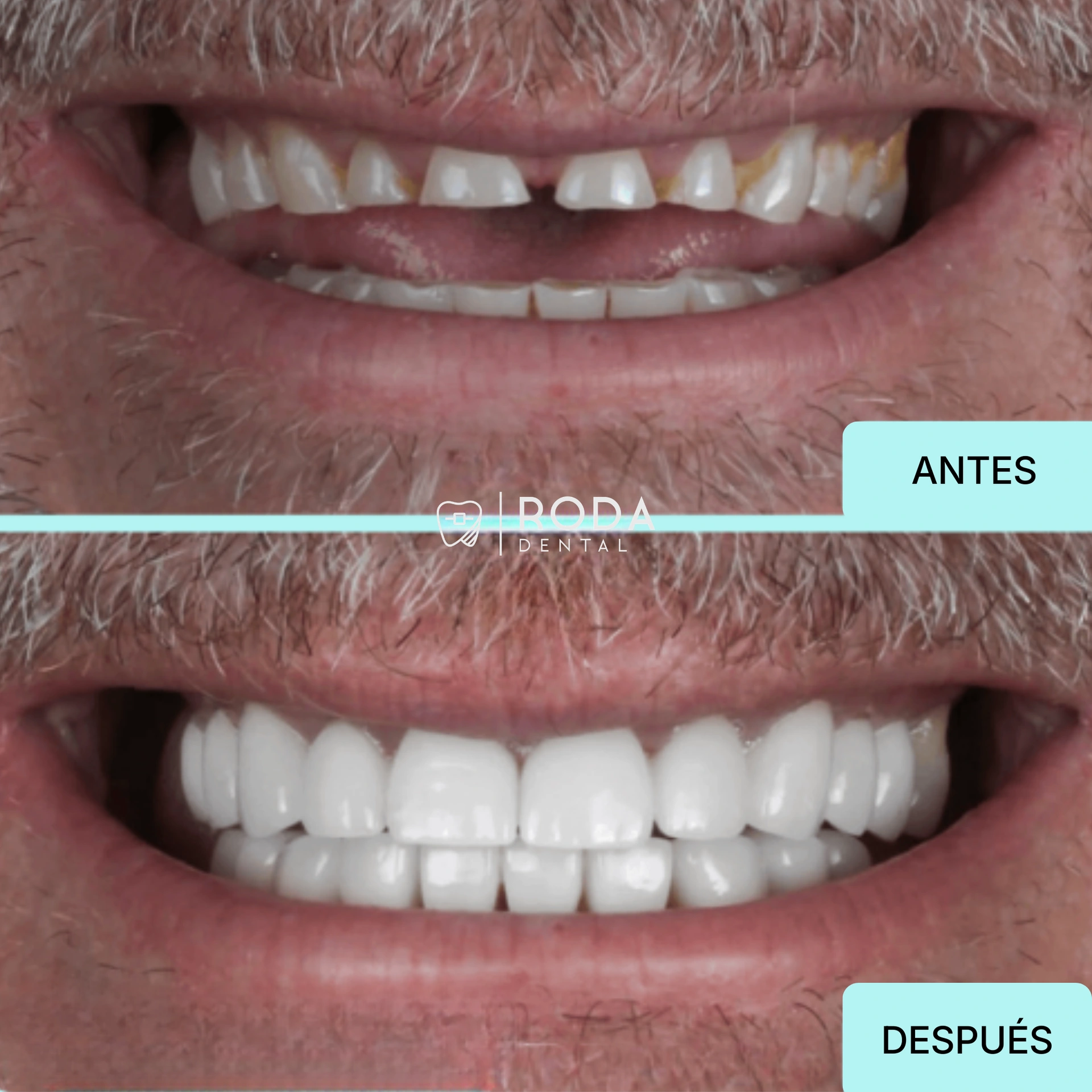 Carillas dentales Guatemala antes y después - sonrisa profesional Roberto Castillo