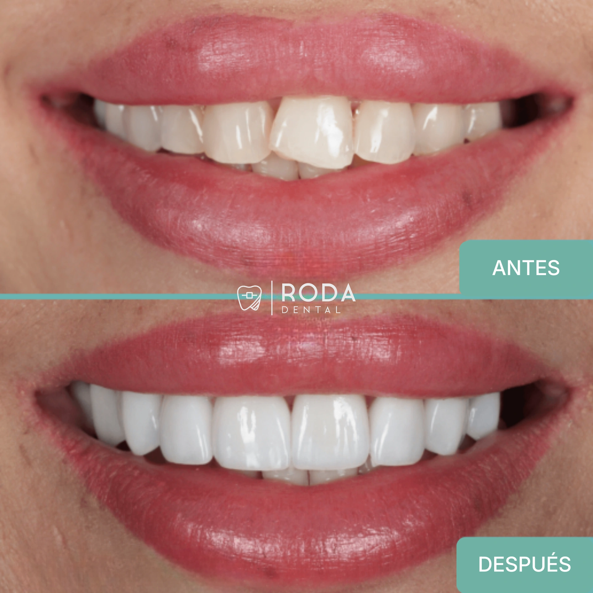 Carillas dentales Guatemala antes y después - sonrisa de boda Sofía Ramírez